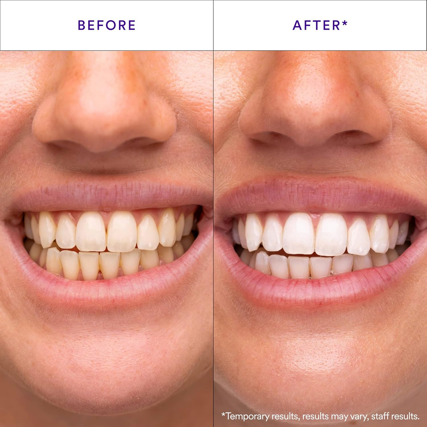 V34 Whitening Strips